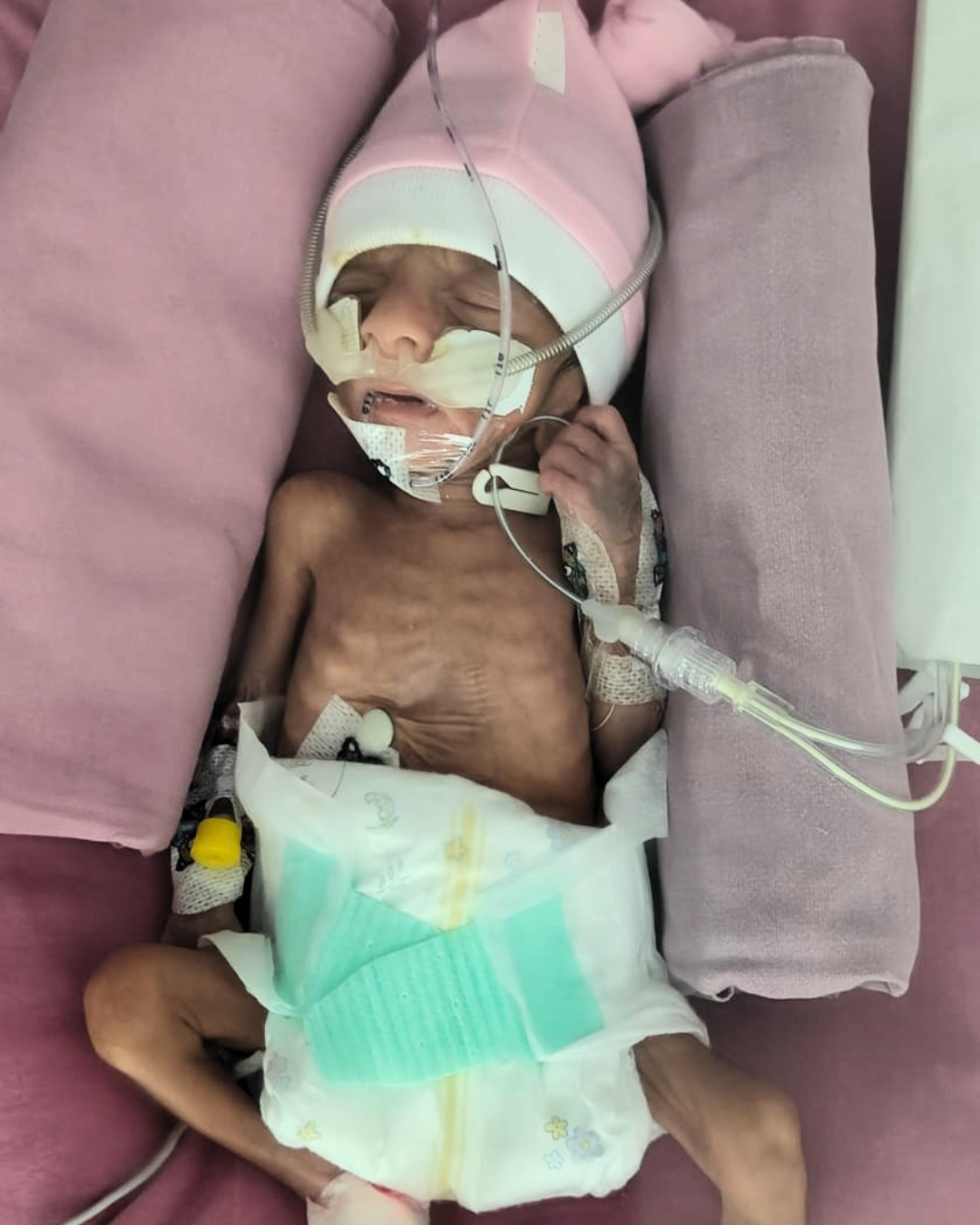Baby of Babita: A 715 Gram Premature Baby