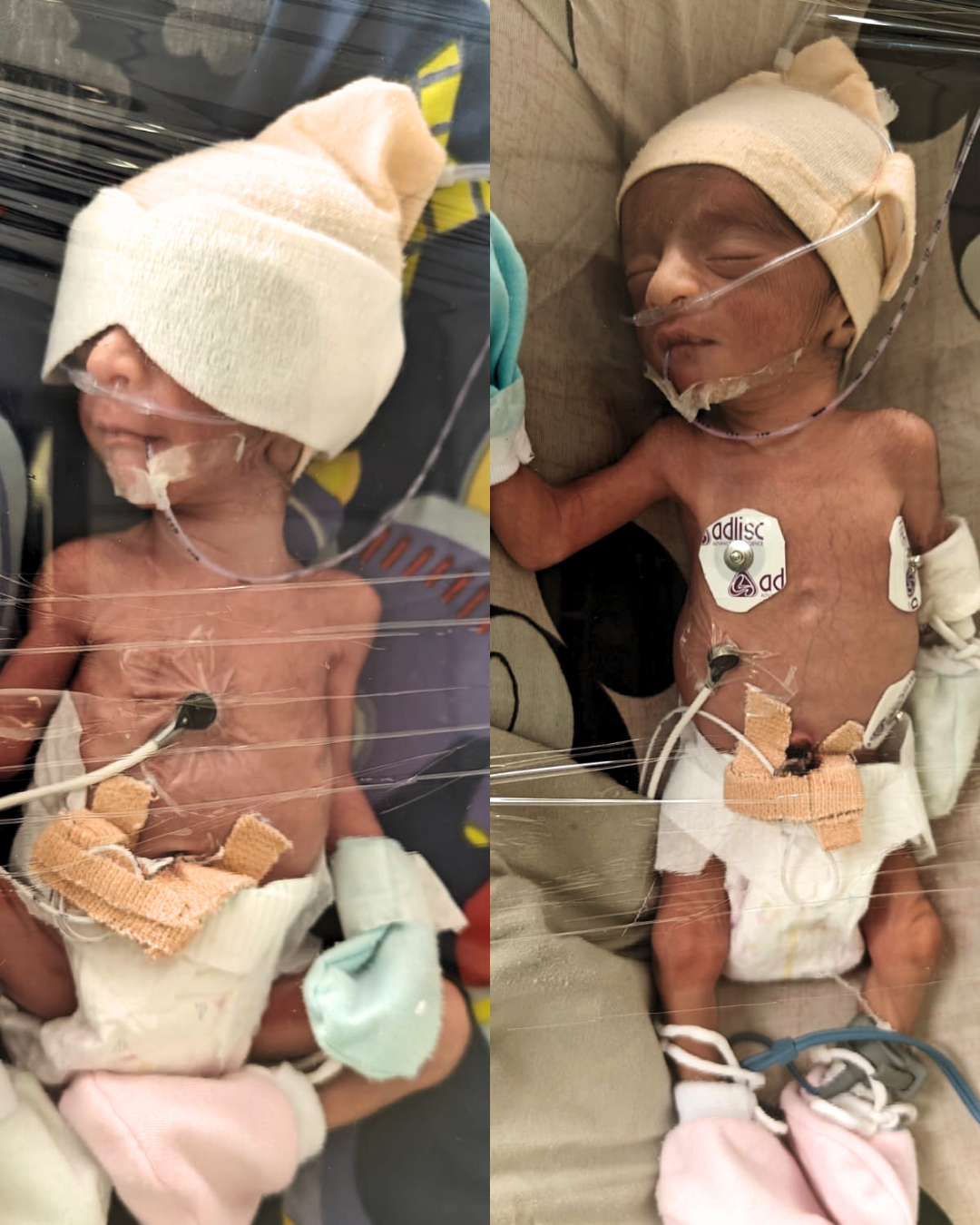 Premature Twin Babies of Anita