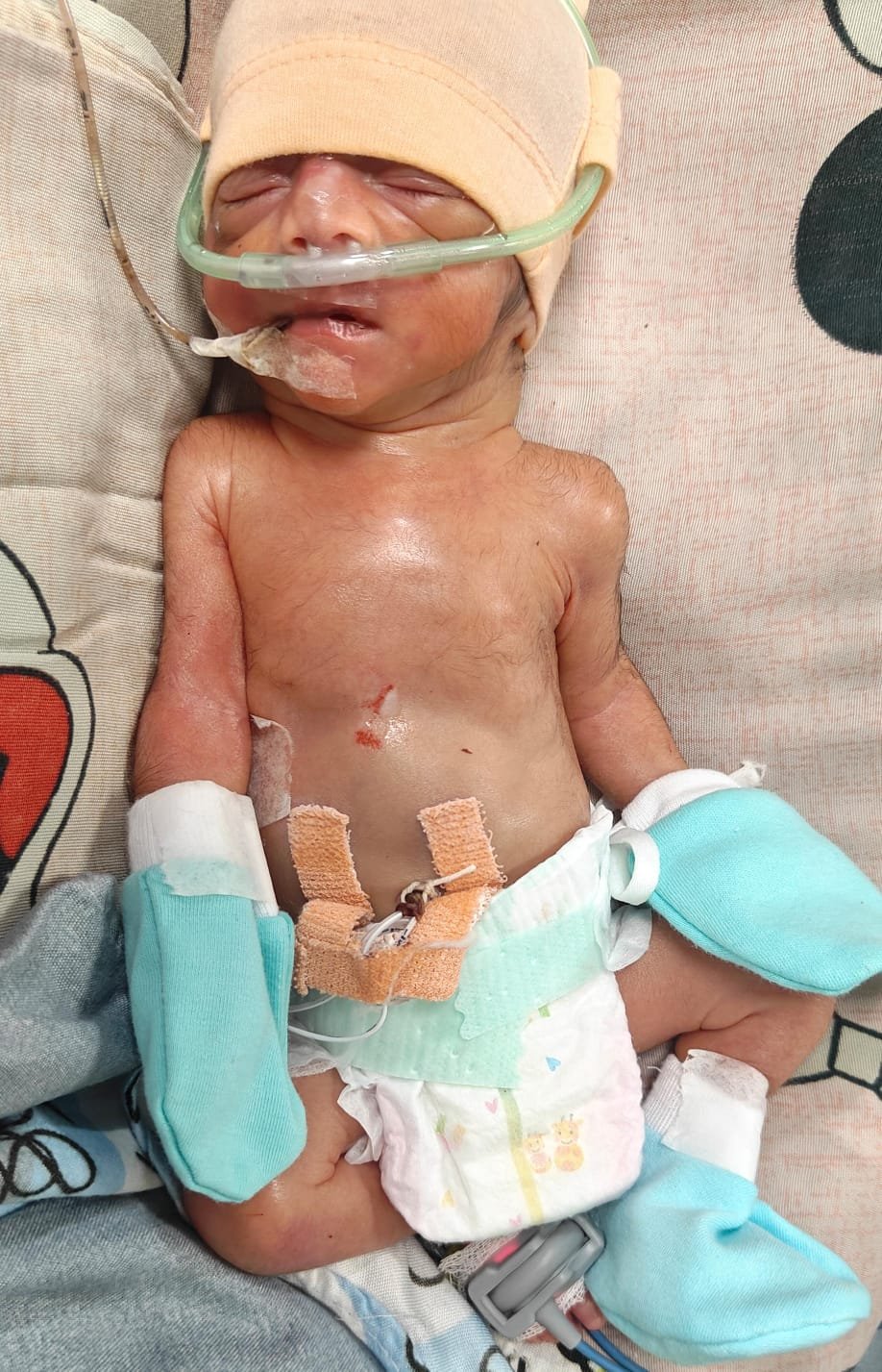 Save Baby of Samda: A Tiny Life Fighting a Giant Battle