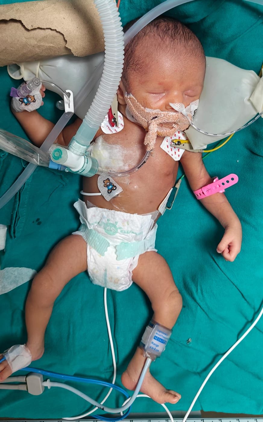 Baby of Rani Needs Your Help 