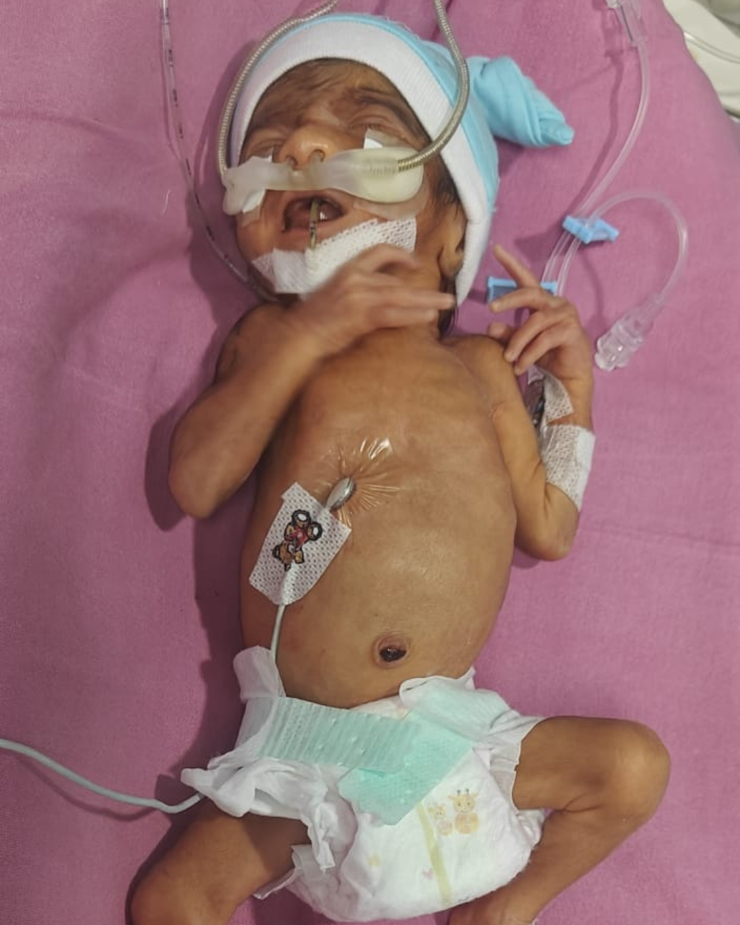 Help Premature Baby Girl Survive