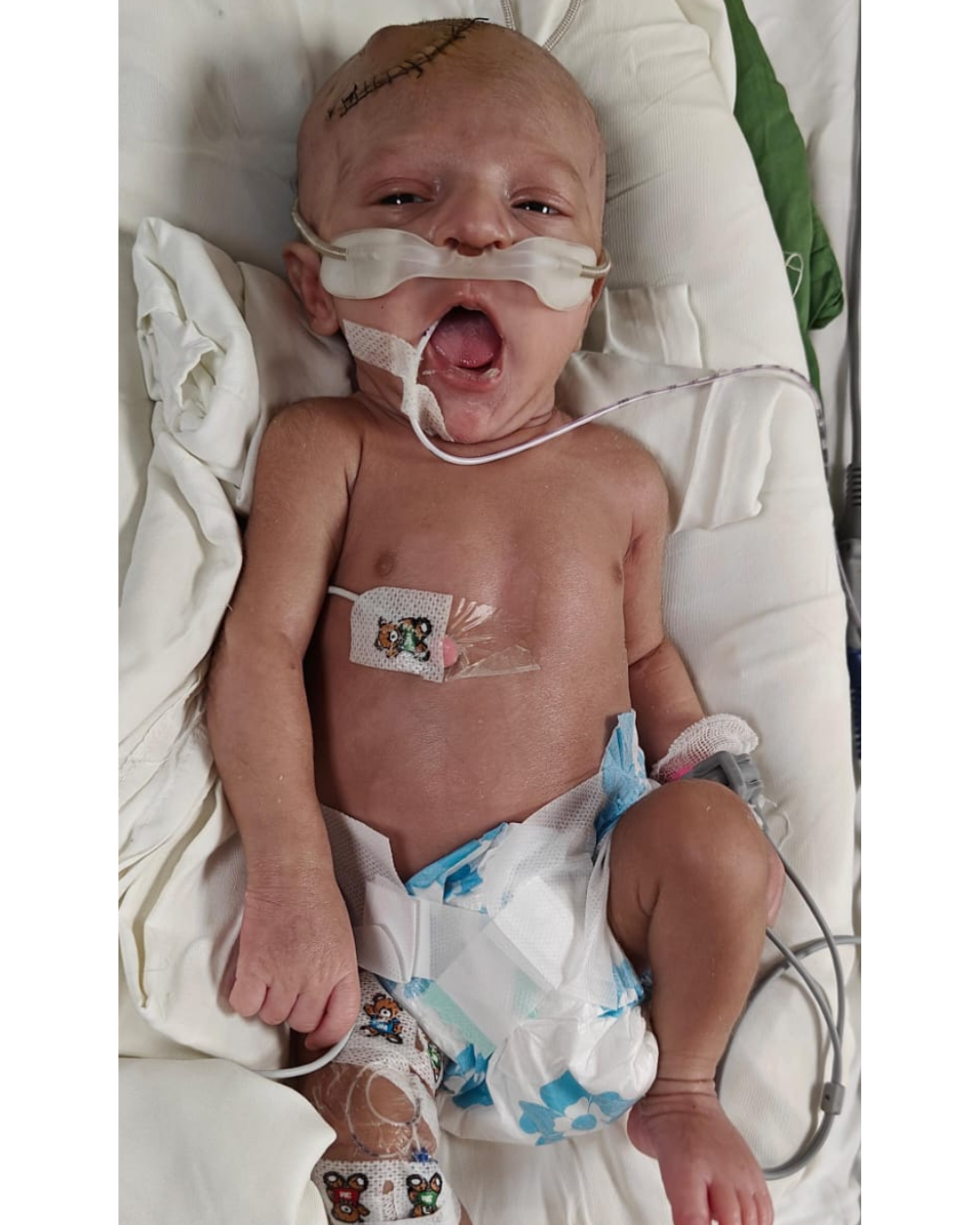 Baby of Bhawna needs urgent 6-7 Lac to survive.