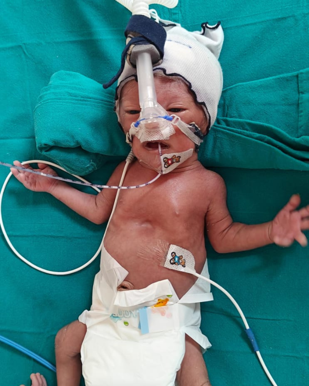 Help Baby of Reeta Breathe Again, Urgent NICU Support Needed!