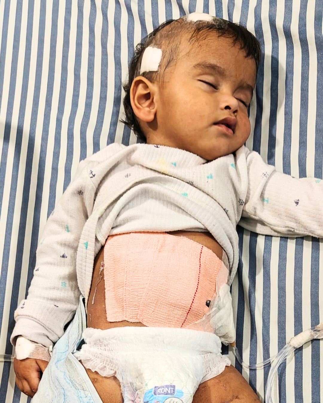 Help Little Kushal Fight a Rare Spinal Tumor, Your Support Can Save His Life.