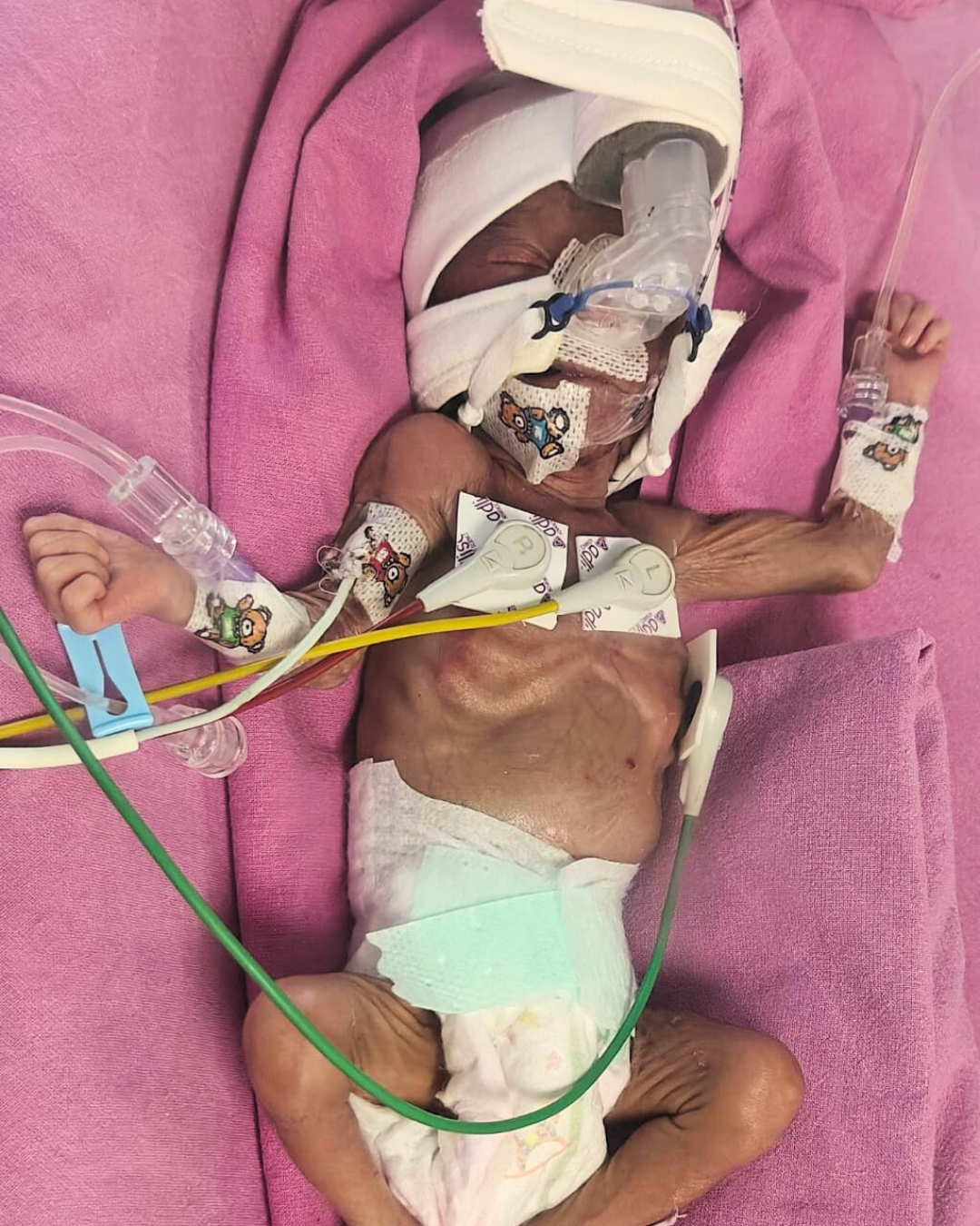 Baby of Shilpi Needs Your Support