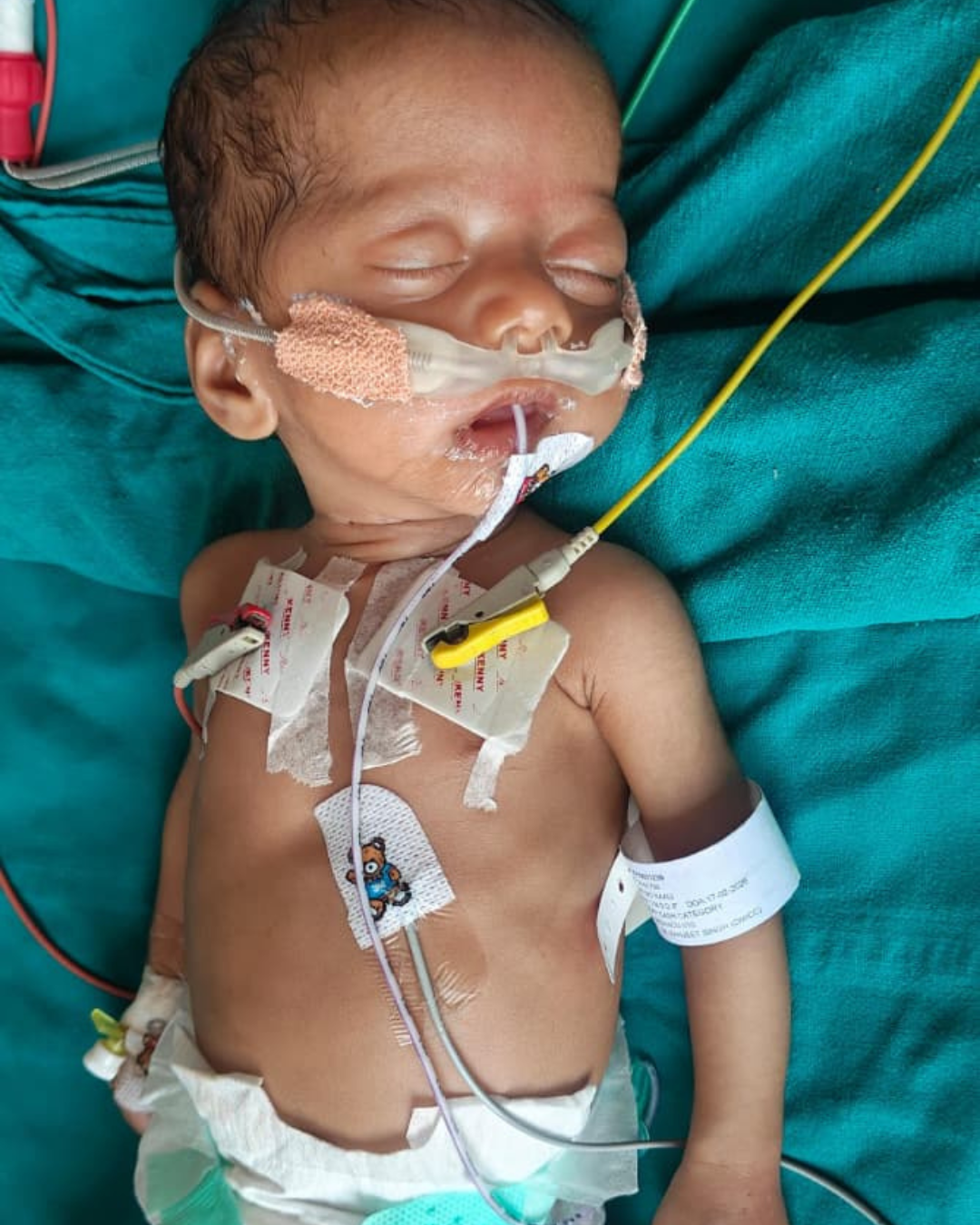 Born Premature Fighting for Every Breath Save Baby of Kaali